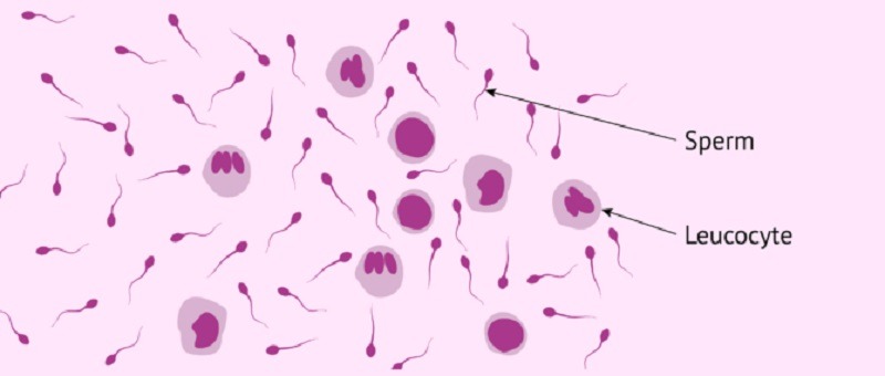 انواع اسپرم غیرطبیعی